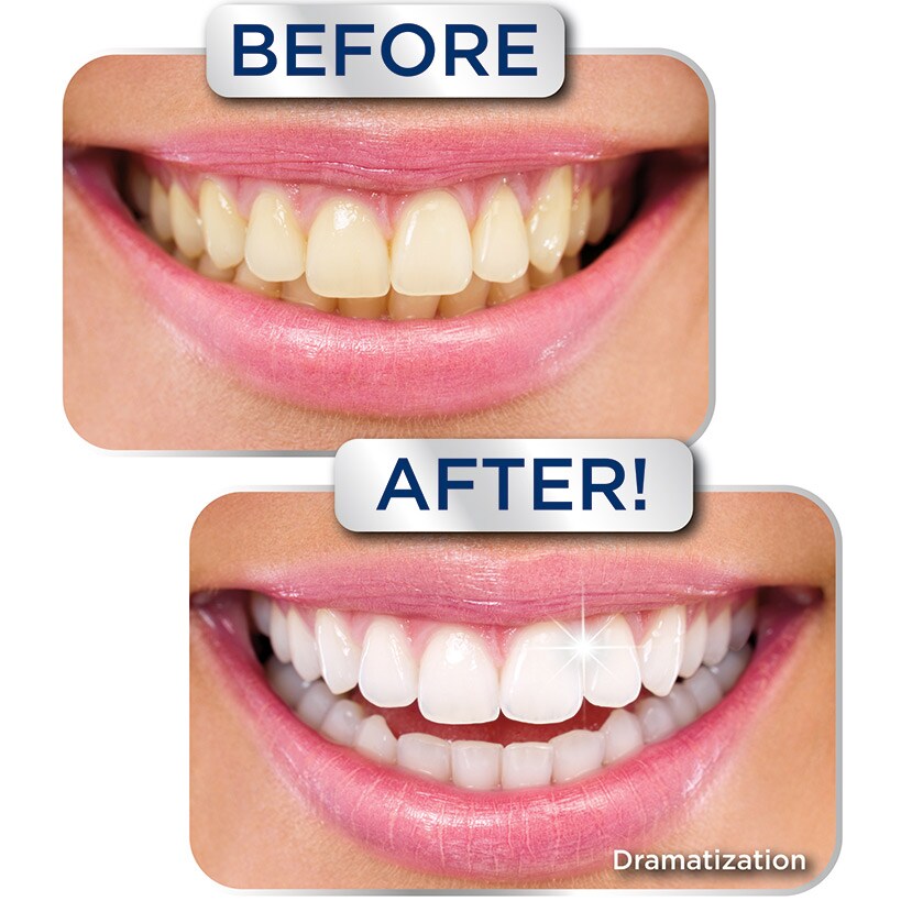 Miracle Smile® Sonic Toothbrush - Ultra Whitening , 5 Cleaning Modes